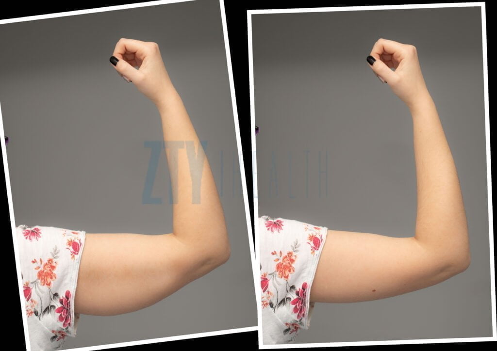 arm lift turkey before after ZTY Health