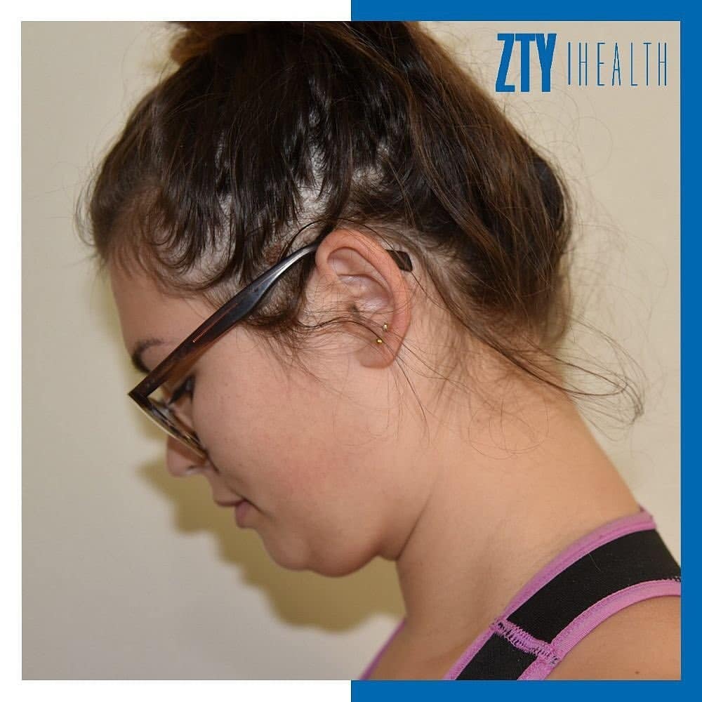 Chin Liposuction Before- Zty Health
