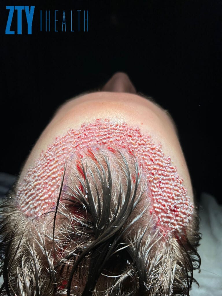 Untrimmed hair transplant Turkey