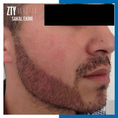 Avant et après la greffe de barbe