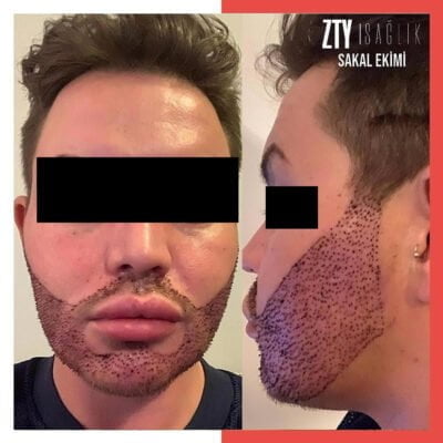 Transplant de barbă în Turcia