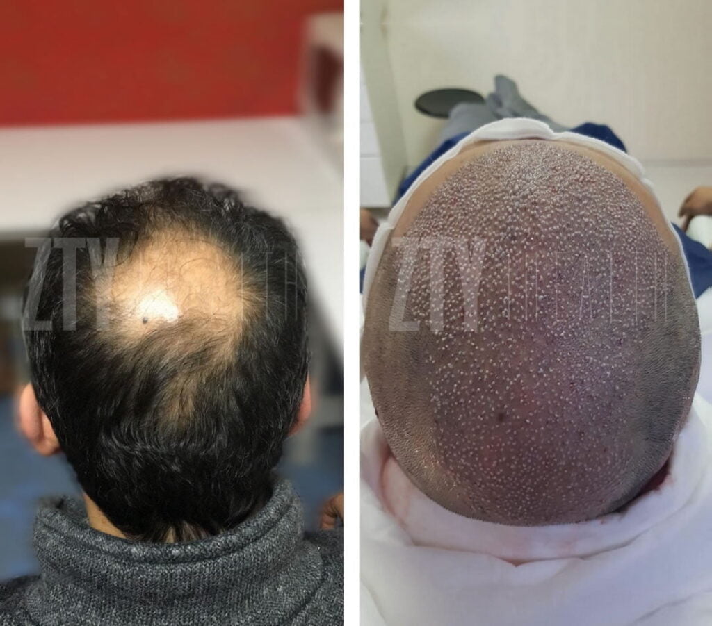 Haartransplantation Türkei Vorher-Nachher -4