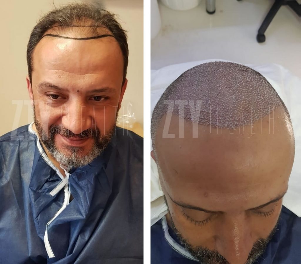 Трансплантация на коса в Турция
