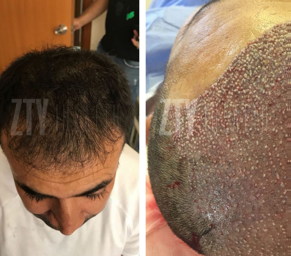 имплантация на коса в Турция